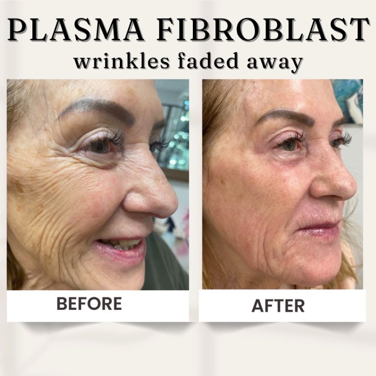 Plasma1