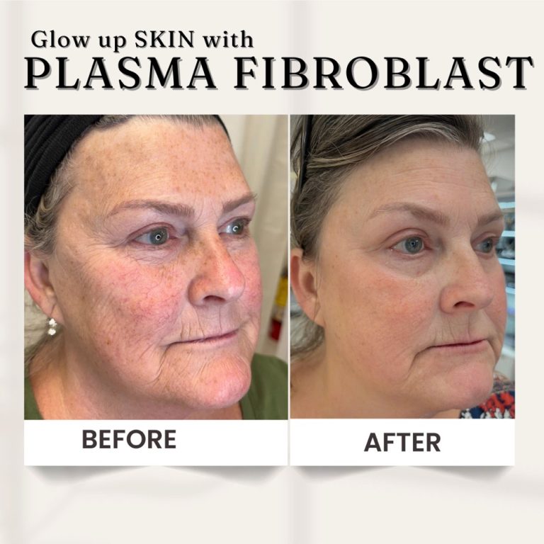 Plasma3
